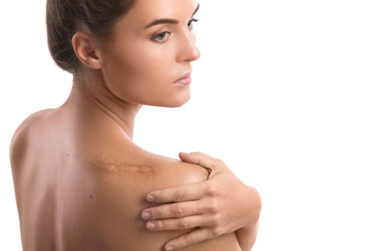 Preventing Keloid Scars