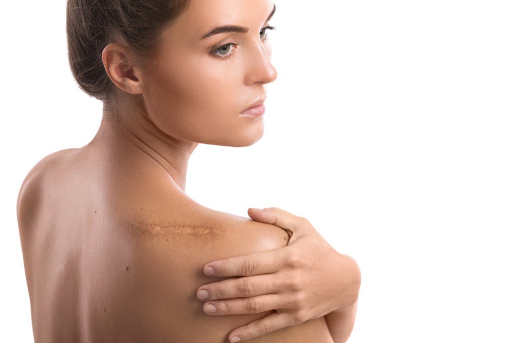 Preventing Keloid Scars