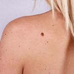 Remove A Mole Without Surgery min