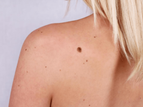 Remove A Mole Without Surgery min