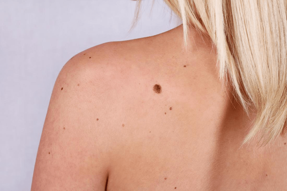 Remove A Mole Without Surgery min